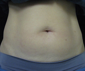 CoolSculpting