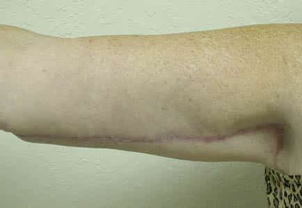 Brachioplasty (Arm Lift)