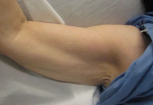 Brachioplasty (Arm Lift)