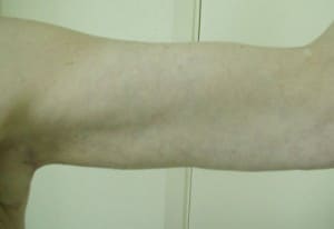 Brachioplasty (Arm Lift)