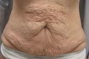 Abdominoplasty