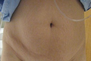 Abdominoplasty