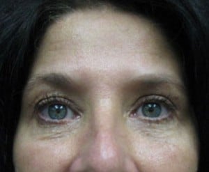Blepharoplasty (Eyelid Surgery)