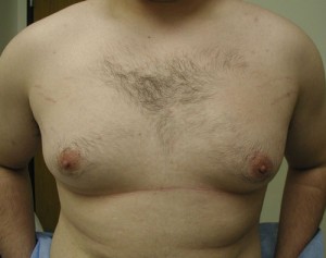Gynecomastia (Male Breast Reduction)