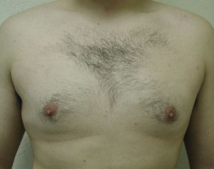 Gynecomastia (Male Breast Reduction)