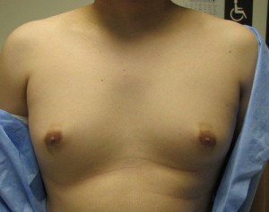 Gynecomastia (Male Breast Reduction)