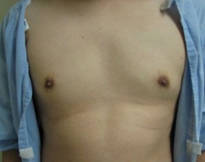 Gynecomastia (Male Breast Reduction)