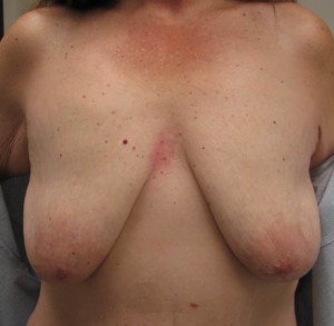 Breast Lift (Mastopexy)