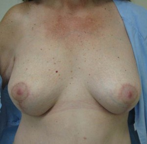 Breast Lift (Mastopexy)