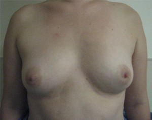 Breast Augmentation