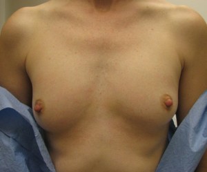 Breast Augmentation