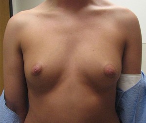 Breast Augmentation