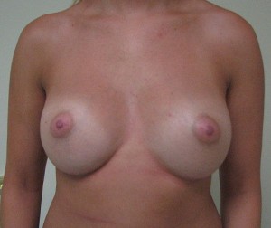 Breast Augmentation