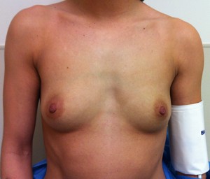 Breast Augmentation