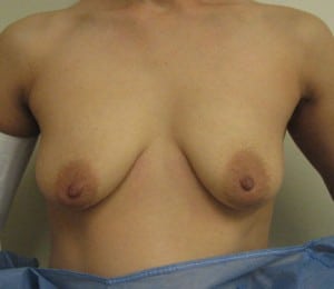 Breast Augmentation
