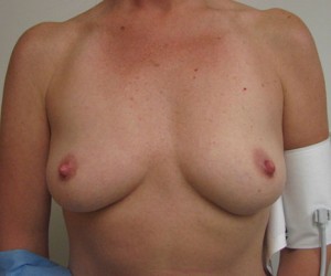 Breast Augmentation