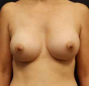 Breast Augmentation