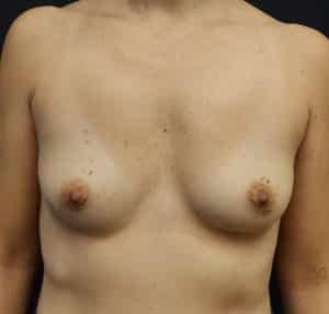 Breast Augmentation