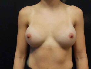 Breast Augmentation