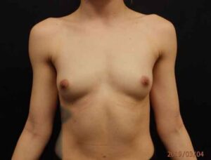 Breast Augmentation