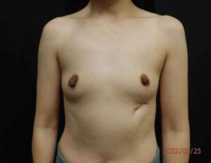 Breast Augmentation