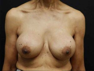 Breast Augmentation