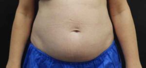 Liposuction