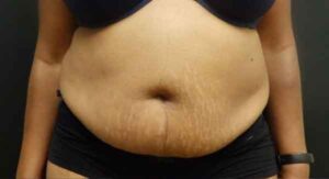 Liposuction