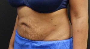 Liposuction