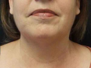Chin Liposuction