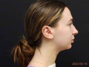 Chin Liposuction