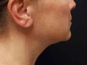 Chin Liposuction