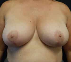 Breast Lift (Mastopexy)
