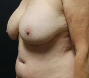 Breast Lift (Mastopexy)