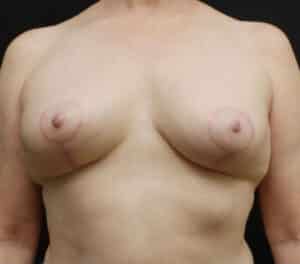 Breast Lift (Mastopexy)