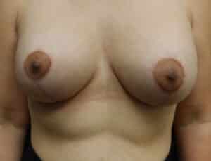 Breast Lift (Mastopexy)