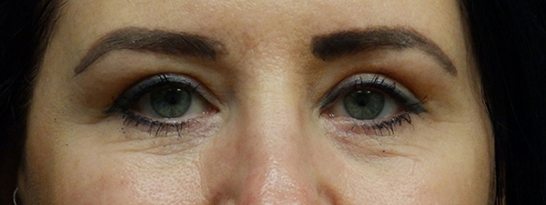 Blepharoplasty (Eyelid Surgery)