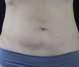 Coolsculpting Before and After