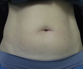 Coolsculpting Before and After