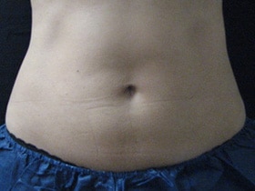 Coolsculpting Before and After
