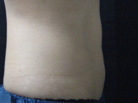 Coolsculpting Before and After