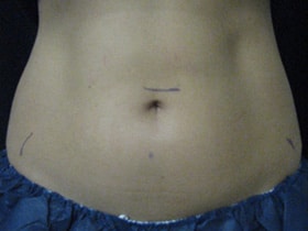 Coolsculpting Before and After
