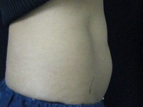 Coolsculpting Before and After